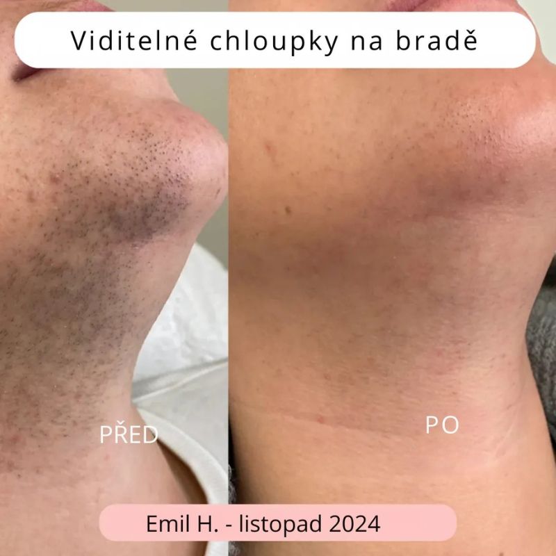 Zastrihávač rozštiepených končekov vlasov™