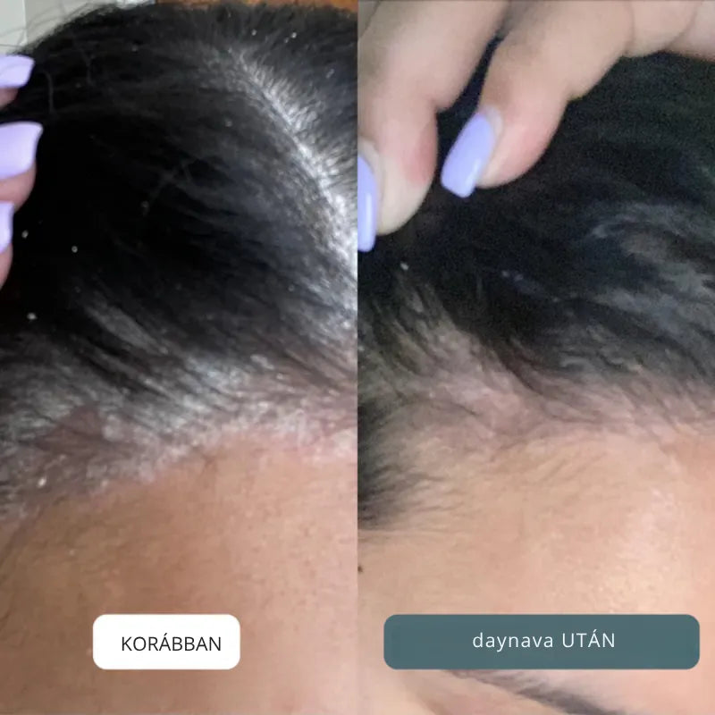 Nyugtató krém fejbőrre és bőrre